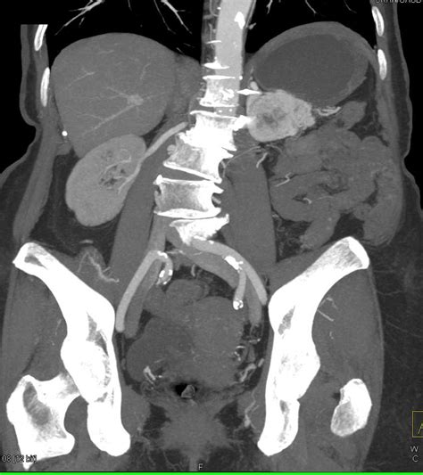 Vascular Metastases To Muscle From Renal Cell Carcinoma