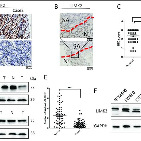 Limk2 Is Progressively Downregulated In Human Crc Tissues A Ihc