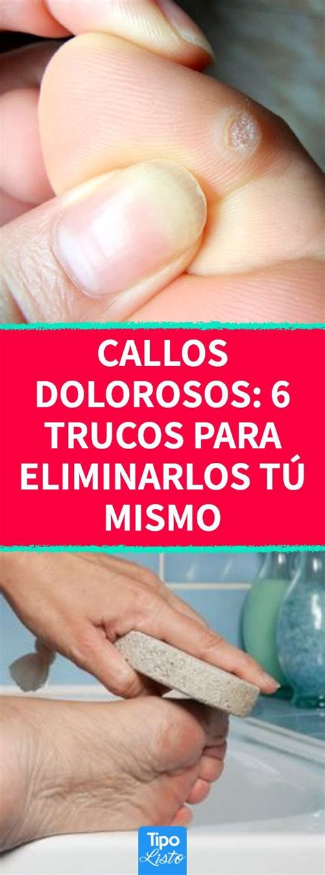 Callos Dolorosos Trucos Para Eliminarlos T Mismo En Eliminar