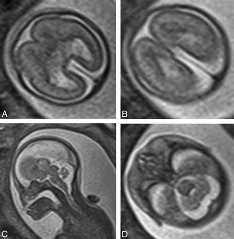 Holoprosencephaly Mri