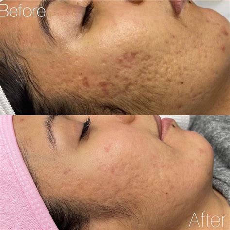 Microdermabrasion For Back Acne Scars Before And After