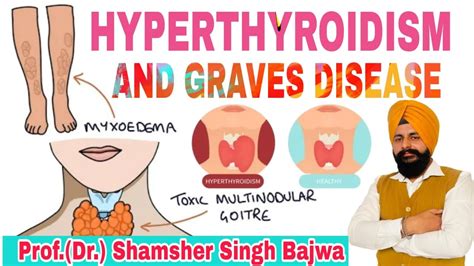 Hyperthyroidism And Graves Disease Cause Lab Test And Treatment Youtube