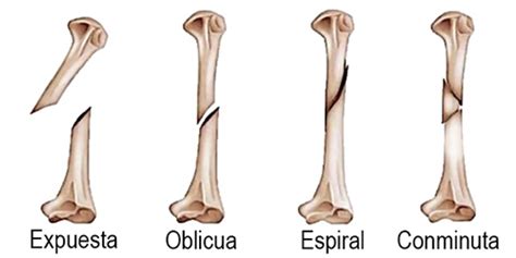 Fracturas Conminutas Images