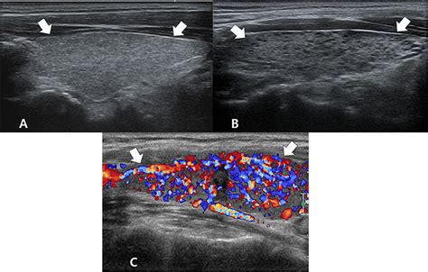 Frontiers Thyroid Imaging Reporting And Data System For Detecting