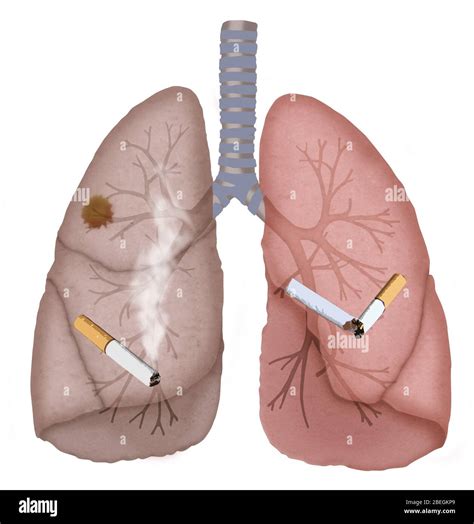 Pulmones Fumadores Sanos Fotos E Im Genes De Stock Alamy