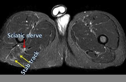 Sciatic nerve | Radiology Reference Article | Radiopaedia.org