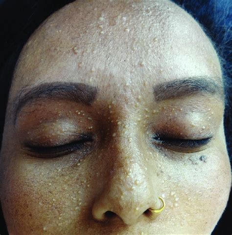 Multiple Facial Milia Characteristic Appearance Of Nose And Sparse