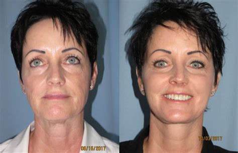 Facial Swelling Face Lift Telegraph