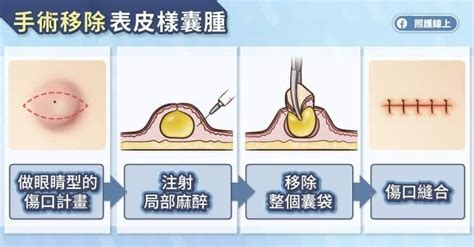 臉上凸起「一粒」竟不是痘痘！醫揭「表皮樣囊腫」特徵、症狀與治療