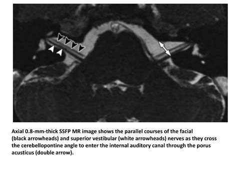 Preoperative Assesment In Cochlear Implantation Ppt