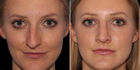 Rhinoplasty Results Atlanta Before After