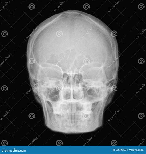 Cranium Stock Image Image Of Socket Black Roentgenogram 65514369