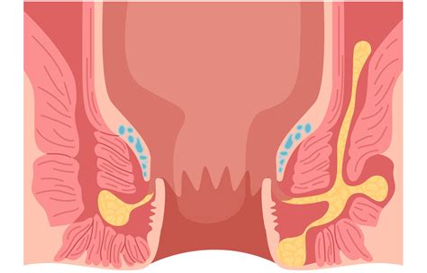 Absceso anal y fístula Dr Adolfo Rivas Cajina