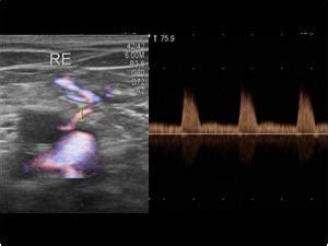 Peripheral vessels | 10.1 Peripheral arteries : Case 10.1.6 True aneurysms, false aneurysms and ...