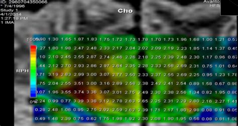 Results for MR spectroscopy metabolites concentrations | Download ...