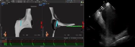 An Example Of The Transseptal Puncture Guided By High Density Mapping