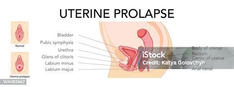 Set Of Uterine Prolapse Female Reproductive System Uterus Labeled In Anatomical Infographic Side