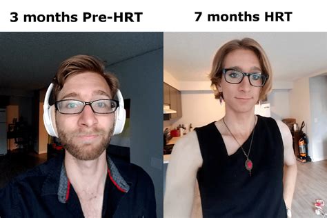 Mtf 3 Months Pre Hrt To 7 Months Hrt Happy With The Progress So Far