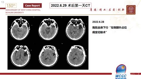 【会议报道】四川大学华西医院胶质瘤多学科诊疗（mdt）院际交流 脑医汇 神外资讯 神介资讯