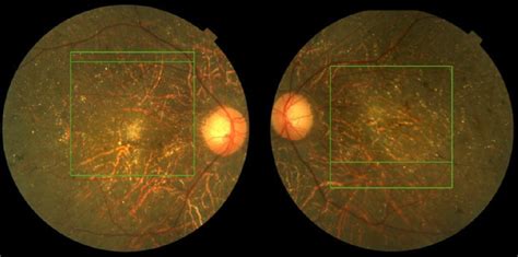 Dots Spots And Other White Retinal Lesions Page 49 Of 61 Retina Revealed