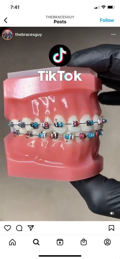 Braces Braces Colors Dental Braces Quick Dental Color Color