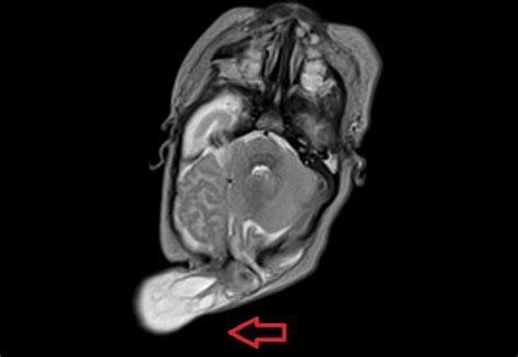 Meningoencephalocele MRI