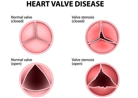 Understanding Aortic Stenosis Symptoms And Treatments Add More To Life Meril