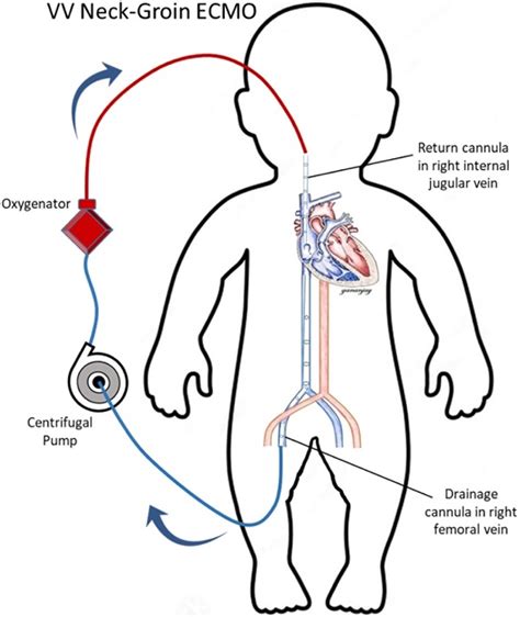 Extracorporeal Membrane Oxygenation In Children A Brief Review