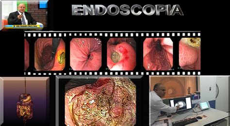 C Ncer Del Colon Gastroenterologia El Salvador Murrasaca