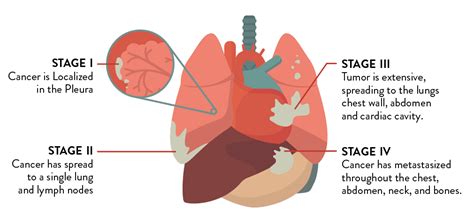 Stages of Mesothelioma Cancer | Your Great Source For All Information