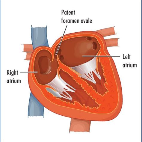 Pdf Diagnosis And Management Of Patent Foramen Ovale