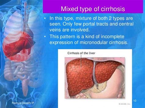 Cirrhosis Of Liver