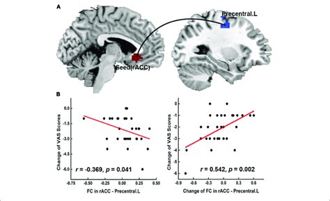 The Seed Based Functional Connectivity Results And Clinical Download Scientific Diagram