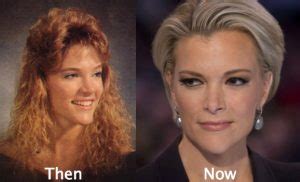 Megyn Kelly Plastic Surgery Before and After Photos