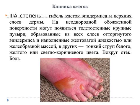Ожоги. Отморожения - презентация онлайн