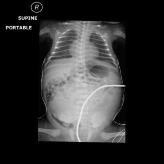 Large obstructed left kidney is demonstrated in MAG-3 renal scan ...