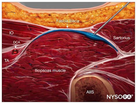 Ultrasound Guided Fascia Iliaca Nerve Block Nysora Nysora