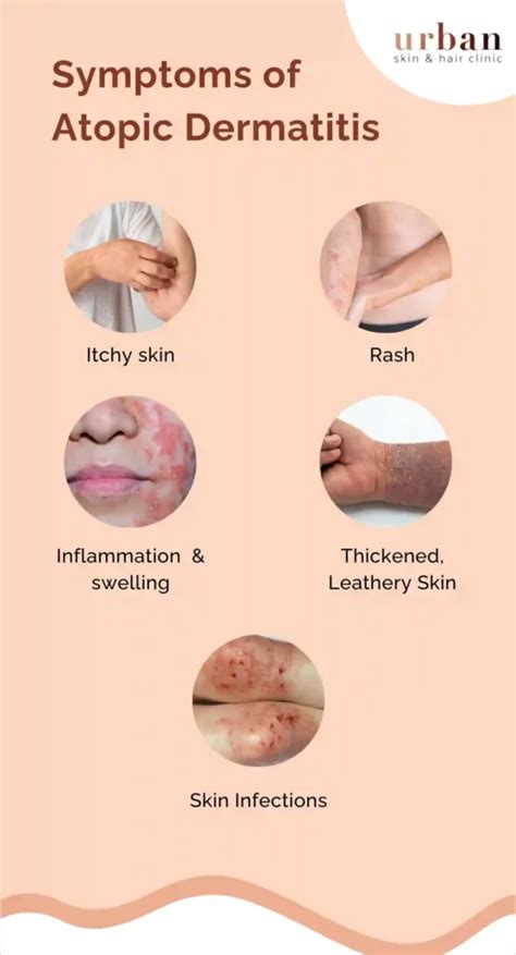 Atopic Dermatitis Types Causes And Symptoms Ushc