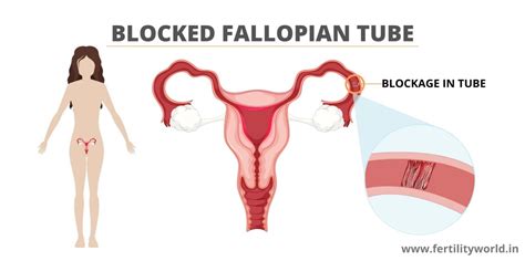 Fallopian Tube Blockage Natural Treatment