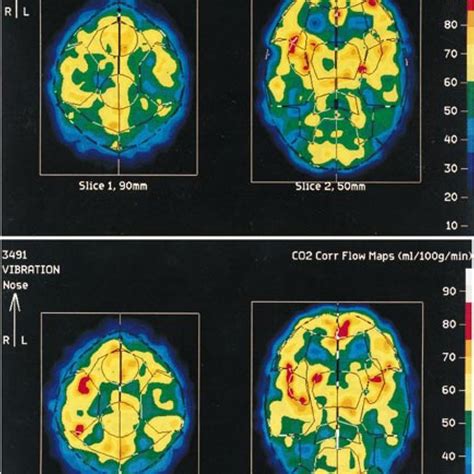 Regional Cerebral Blood Flow Measured In Slices Orbitomeatal Om