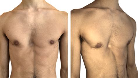 Pectus Excavatum Chest