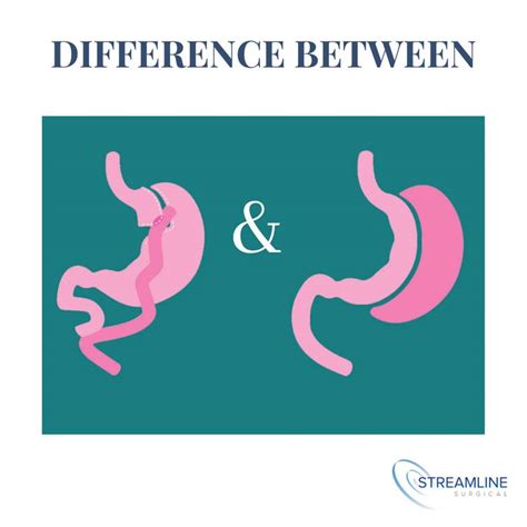 Difference Between Gastric Bypass And Gastric Sleeve Streamline