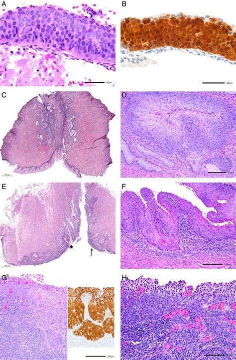 Hpv Negative Squamous Cell Carcinomas Of The Cervix With Special Focus