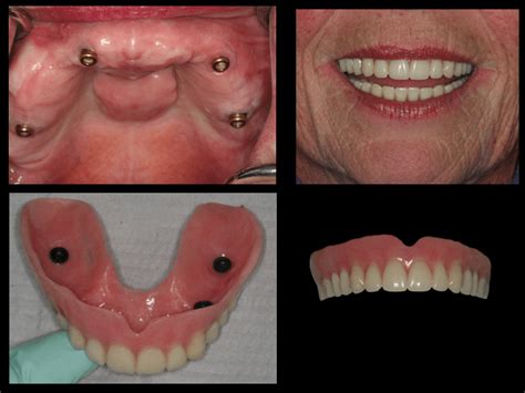 Dentures That Snap Onto Dental Implants Or Implant Retained Denture