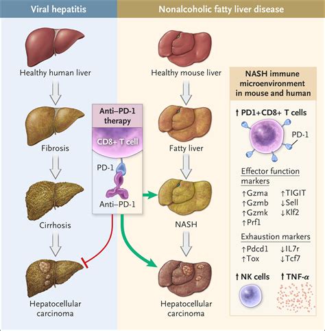 Hepatocellular Carcinoma Origins And Outcomes Nejm