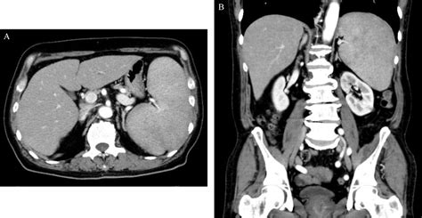 Figure 1 From Successful Treatment Of Severe Splenic Lymphoma