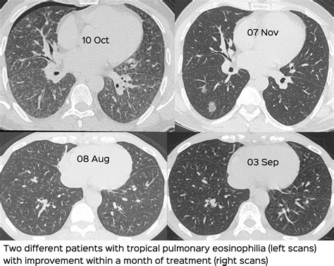 Case 12 Tropical Pulmonary Eosinophilia