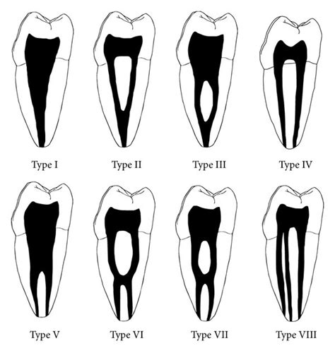 Vertucci’s classification of root canal morphology [6]. | Download Scientific Diagram