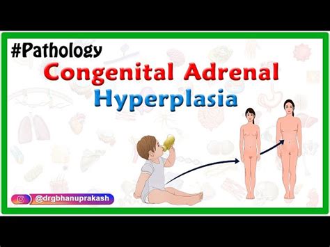 Congenital Adrenal Hyperplasia