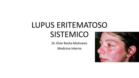 Lupus Eritematoso Sistémico Violet Isabella uDocz